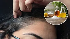 Harmaat hiukset kellastuvat? Näin kirkastat sävyä omenaviinietikalla ja ruokasoodalla